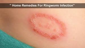 home remes for ringworm infection