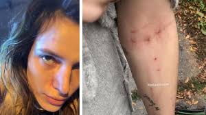 are bella thorne s track marks really