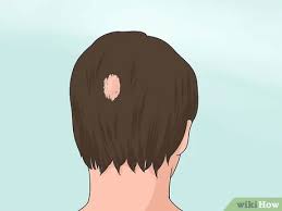 Alright, so since early summer 2012, a few months before i turned 16, i started to notice my receding hairline. 4 Ways To Stop Teen Hair Loss Wikihow