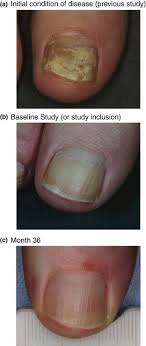 efficacy of amorolfine nail lacquer for