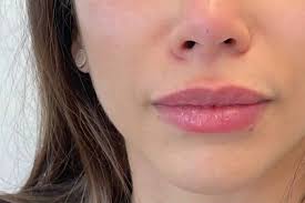 types of lip fillers and faqs cal