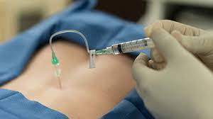 epidural steroid injections what to