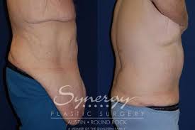 post weight loss surgery before and