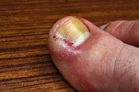 an ingrown toenail without surgery