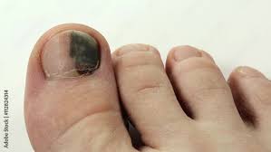 toenail subungual hematoma injury