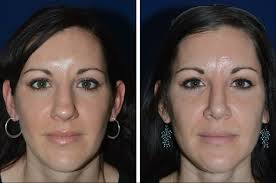 heal after rhinoplasty