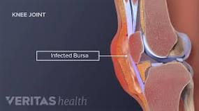 Septic Bursitis: The Serious Side of Bursitis | Arthritis-health