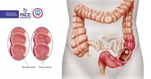 colon cancer symptoms causes