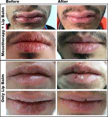 lip mesotherapy with dexpanthenol in