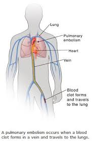 Respiratory muscle training the benefits of using. Pulmonary Embolism Pe Articles Mount Nittany Health System