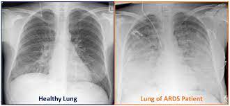 In ards there is intense inflammation of the lung tissue, which can. R D Pantherna Therapeutics Com