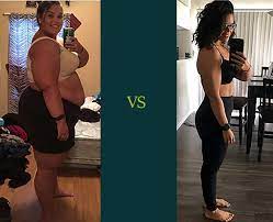 weight loss surgery before after photos
