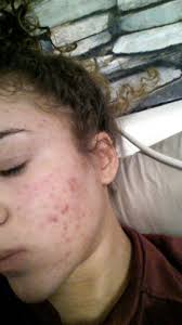 Sie gehört zu den häufigsten hautkrankheiten und wird durch hormonelle schwankungen hervorgerufen. Hilfe Ich Leide Unter Akne Gesundheit Beauty Haut