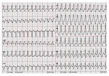 Image result for icd-10 code for wide complex tachycardia