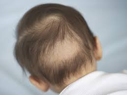 baby hair loss when do es lose