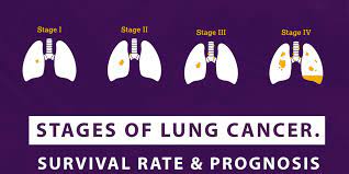 ses of lung cancer survival rate