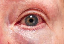 damaged cornea symptoms and