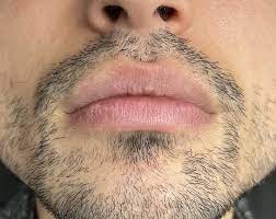 upper lip vermillion border