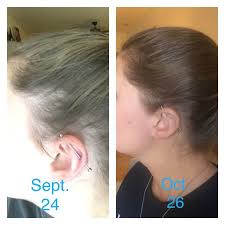 Then, i'll share some tips that will help you to speed up regrowth and bring your hair back to its. Pin Pa Monat Before Afters
