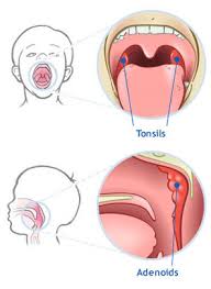tonsillectomy and adenoidectomy ent