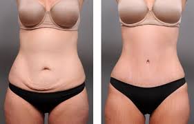 how long is tummy tuck recovery time