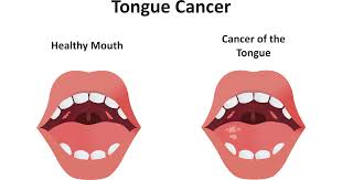 tongue cancer symptoms ses causes