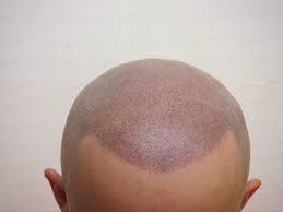薄毛の悩み（スキンヘッド仕上） | SPJ ヘアタトゥー施術例画像・写真