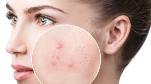 natural and gentle home remes for acne