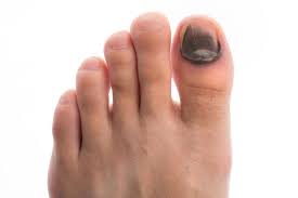 runners make that damage their toenails