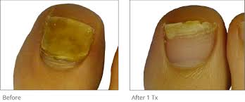 toenail fungus lasers laser treatment