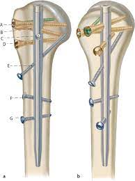 8 proximal humeral nail multiloc