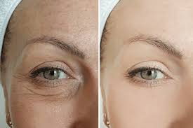 microneedling under eyes what to