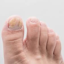 an overview of mon toenail problems