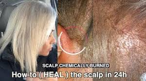 After a shelf life of six months, bleach starts to degrade. Severe Scalp Chemically Burned How To Heal The Scalp After Bleached Your Hair It Work Youtube
