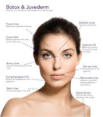 Botox Juvederm Diagram Of Face Botox Injection Sites