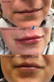 female lip filler with restylane kysse