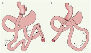 roux en y gastric byp for obesity