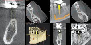 cbct can impact implant placement