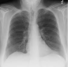 Learn more on this topic. Chest Radiograph