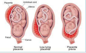 low lying placenta at 20 week scan