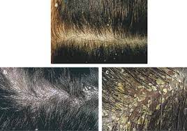 home remes for dandruff hair loss
