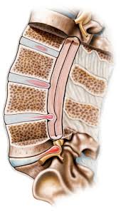 healing herniated disc without surgery
