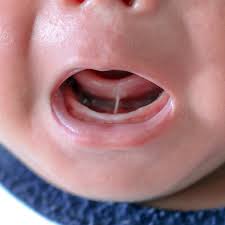 lip tie in es toddlers symptoms