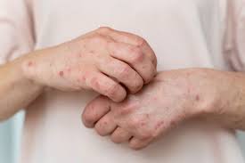 eczema atopic dermais