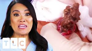 Whether you are a dr. It S Like Ground Beans Dr Pimple Popper Youtube