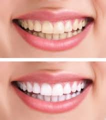 home teeth whitening kits