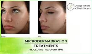 microdermabrasion treatments procedure