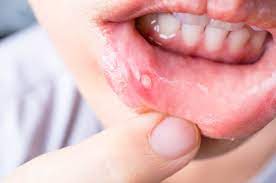 treating canker sores aphthous ulcers