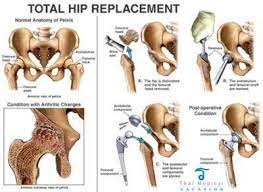 total hip replacement surgery