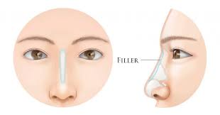 nose fillers